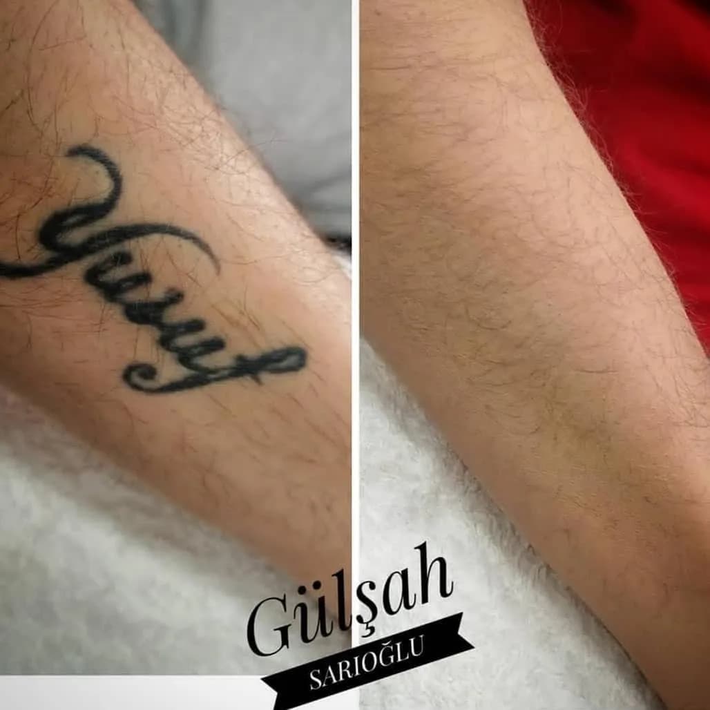 Kol dövmesi kapatma — öncesi ve sonrası — Ömer Sarıoğlu Güzellik Salonu
