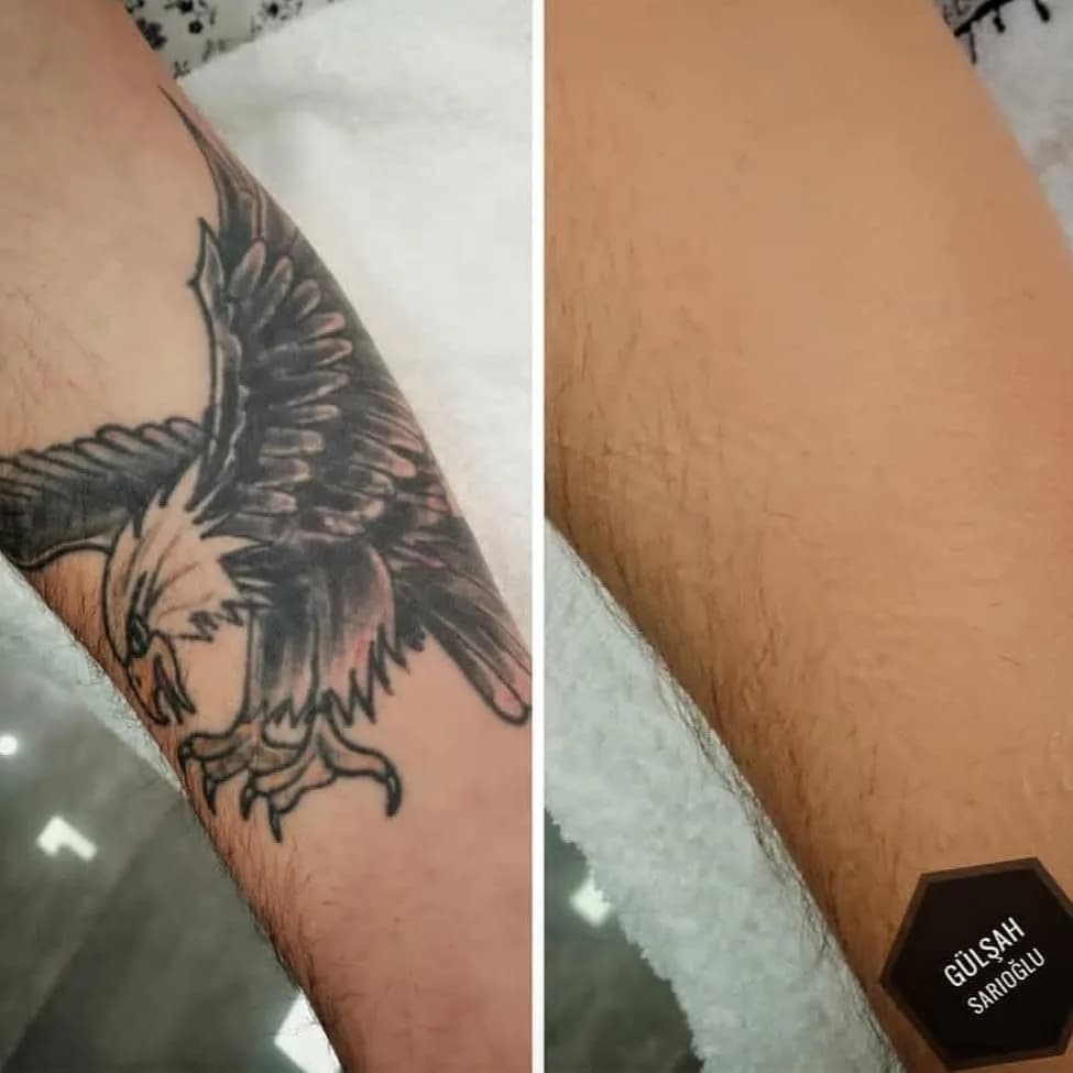 Kartal dövmesi kapatma — öncesi ve sonrası — Ömer Sarıoğlu Güzellik Salonu